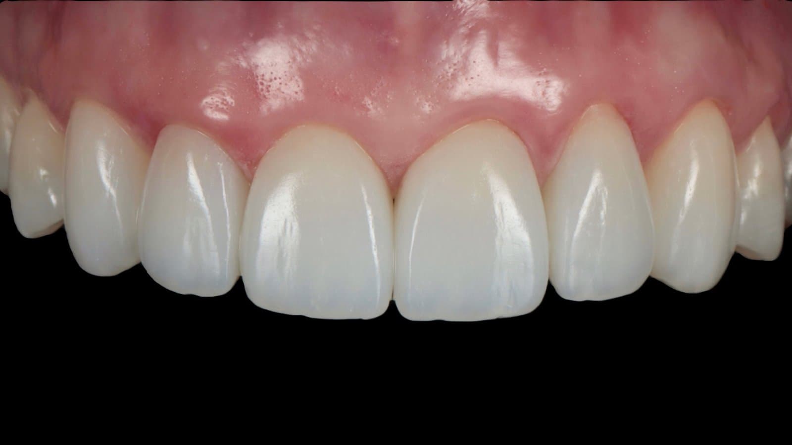 Six layered composite veneers by Dr Albert Gajdos, after treatment