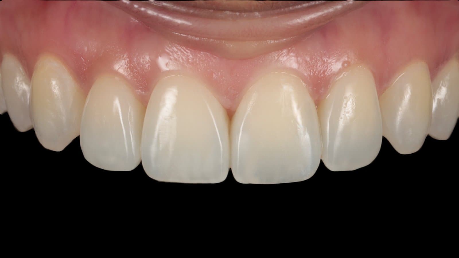 Four layered partial composite bondings by Dr Albert Gajdos, after