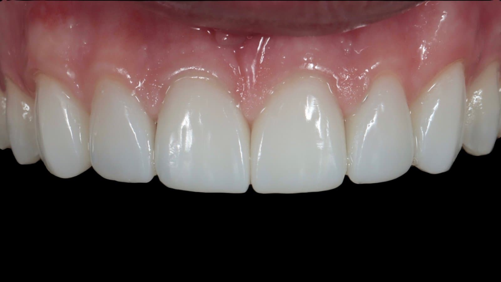 A diastema closed with six single-shade composite veneers, after
