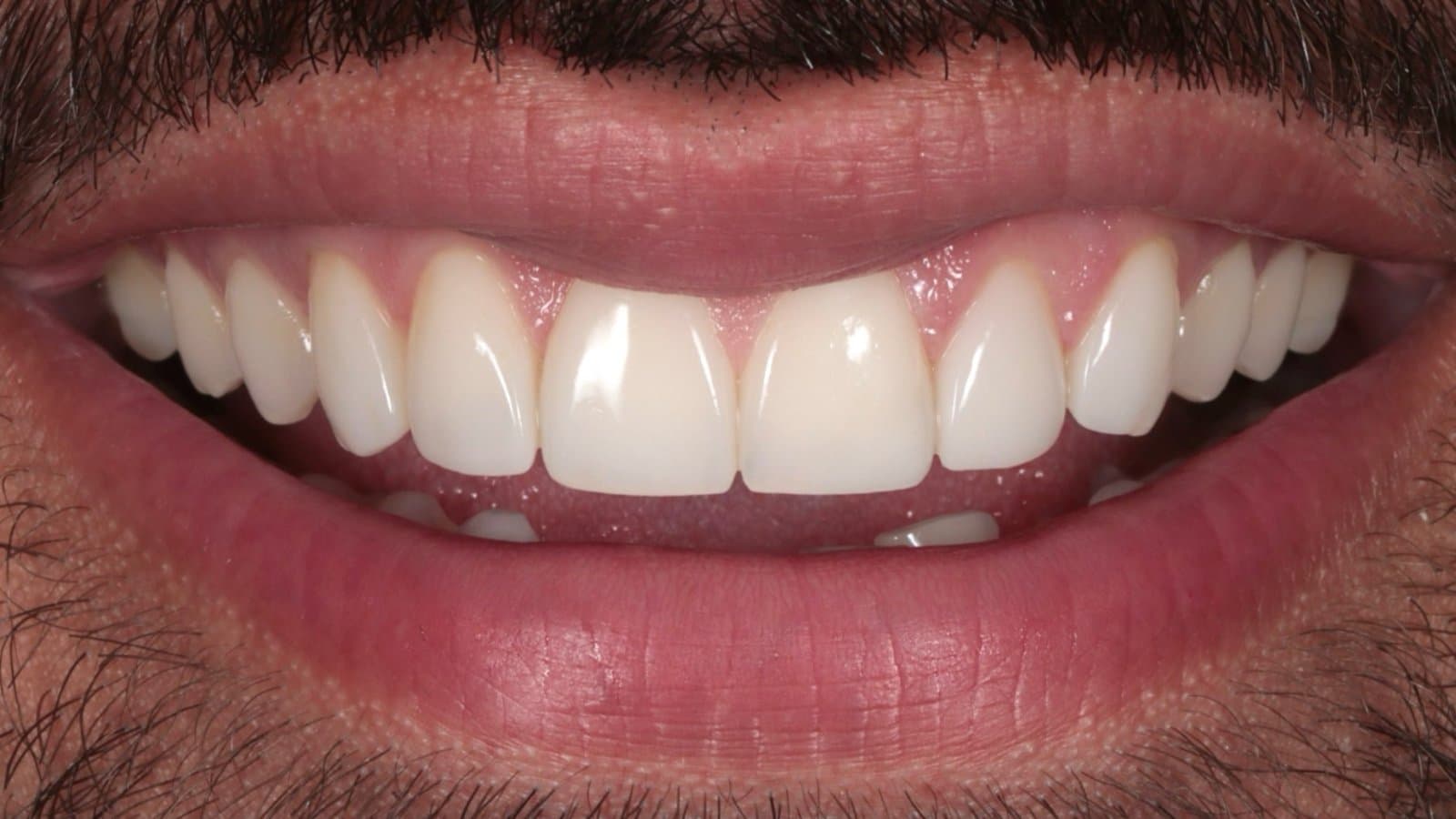 Six composite veneers by Dr Albert Gajdos at a recall five and a half years after fitting