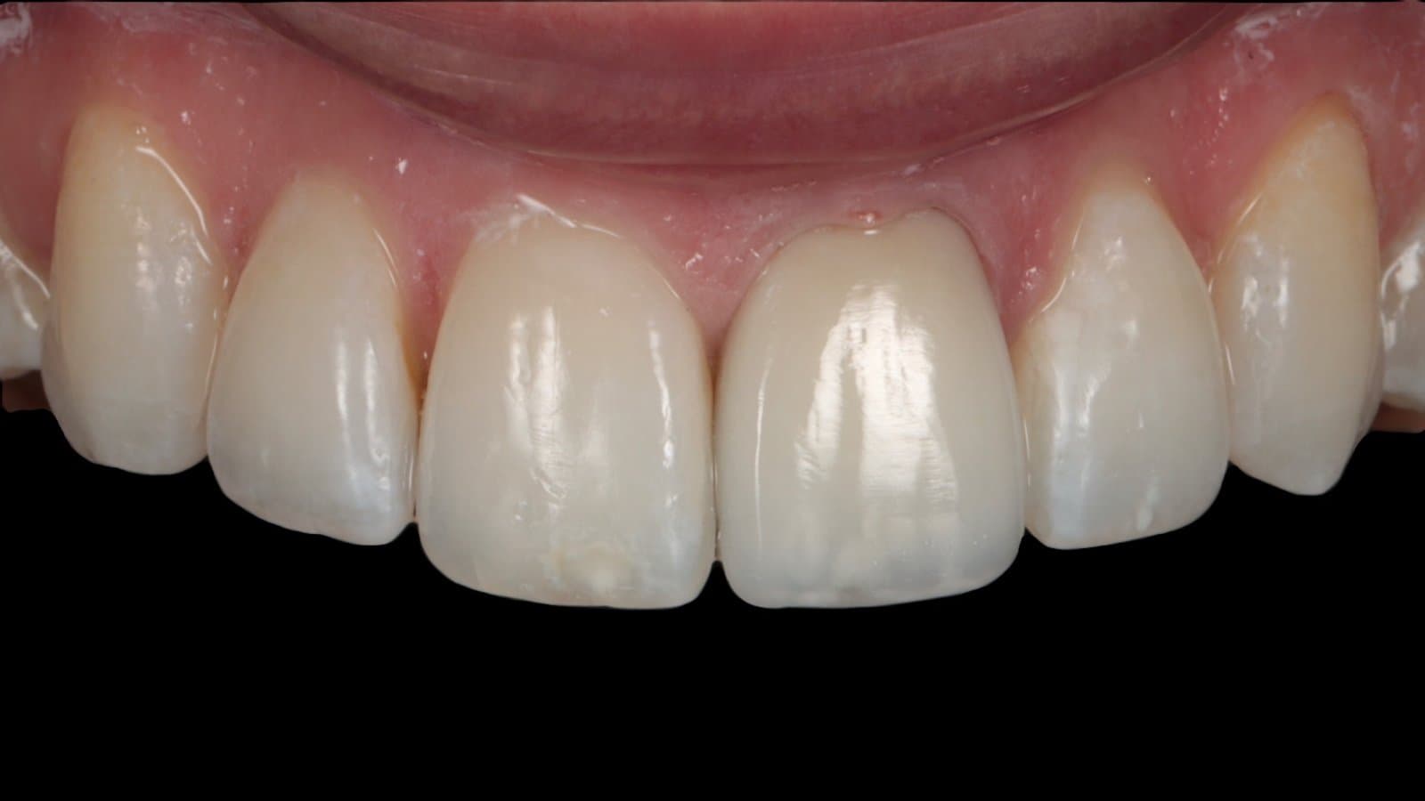 A single layered composite veneer on a discoloured tooth, after