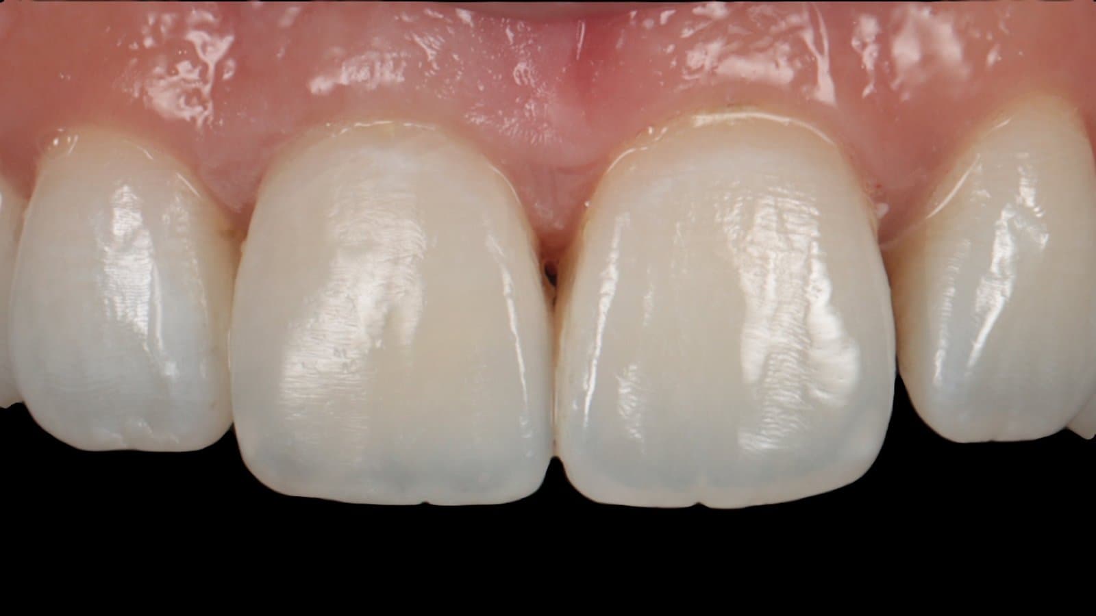 A layered Class IV composite restoration by Dr Albert Gajdos, after