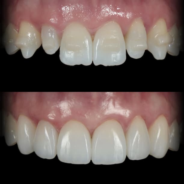 Anterior composite veneers by Dr Albert Gajdos on chipped, worn upper incisors, before treatment