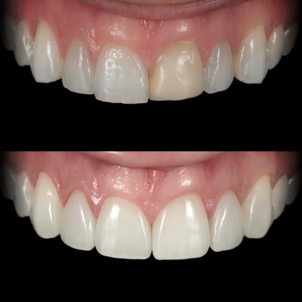 Composite veneers by Dr Albert Gajdos on a discoloured upper front tooth, before treatment
