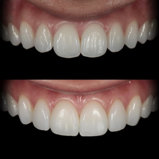 Composite veneers by Dr Albert Gajdos lengthening short, worn upper front teeth, before treatment