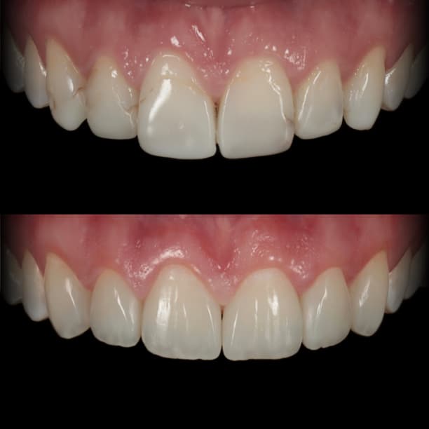 Composite bonding by Dr Albert Gajdos on an uneven, short upper lateral incisor, before treatment