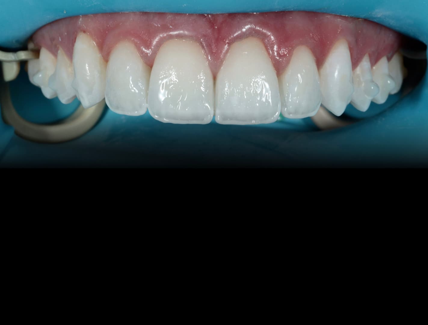 Anterior composite restorations under rubber dam: the layered work taught on the Simplifi Layering course