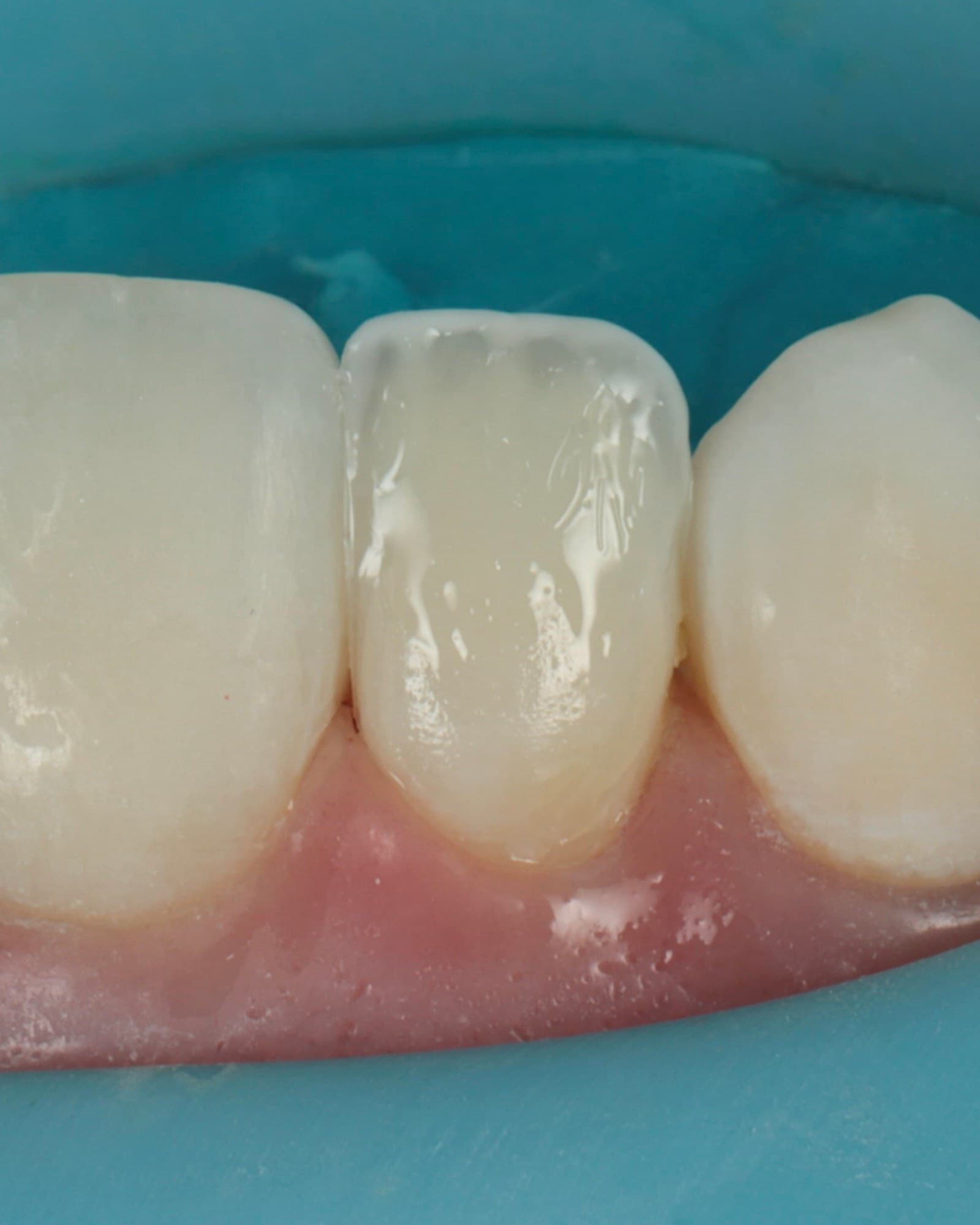 A live composite case under rubber dam